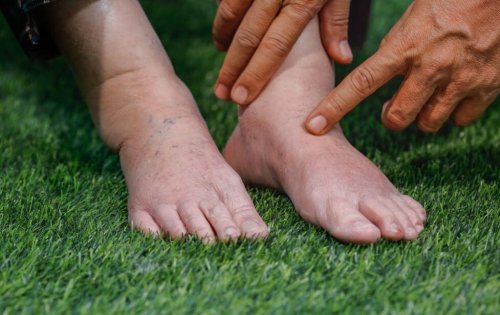 vochtretentie in benen