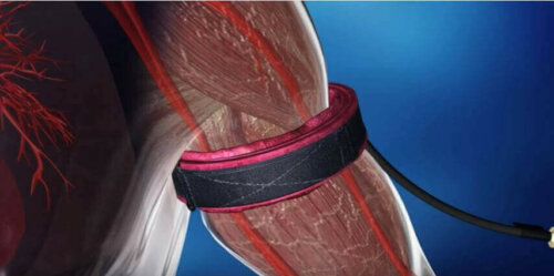 De bloedsomloop afknellen